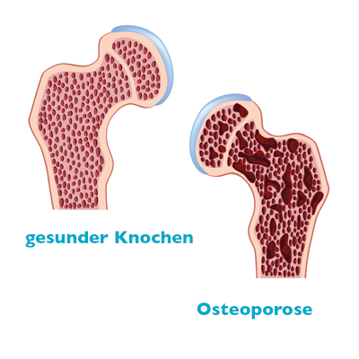 Osteoporose